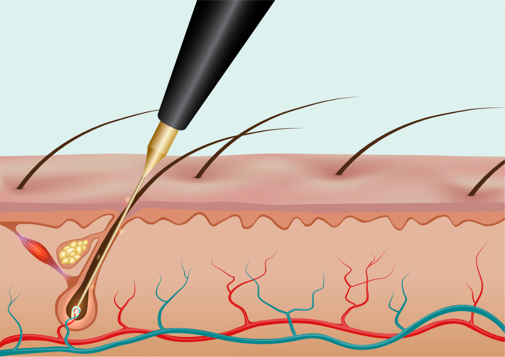 remove ingrown hairs for good with electrolysis!