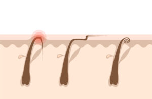 Ingrown hair - Real You Electrolysis