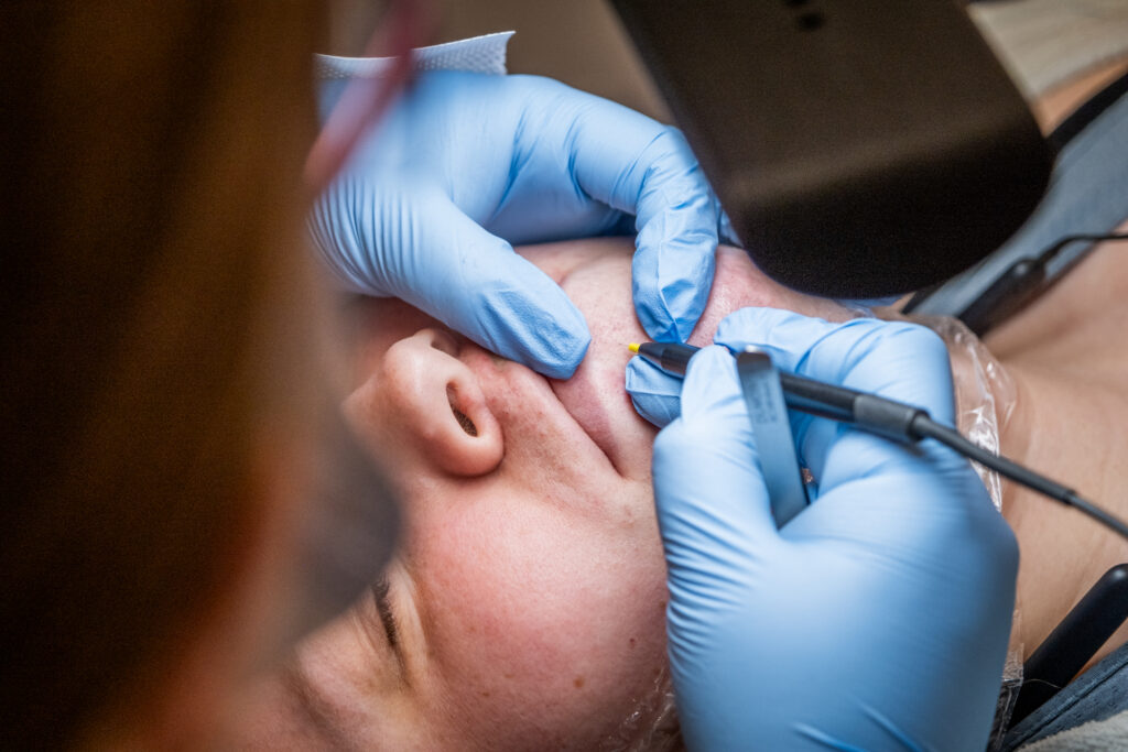 An image of electrolysis hair removal being performed. The provider is inserting a tiny handpiece into a patient's hair follicle. The provider will then send electricity into the hair follicle, killing the hair, which is then tweezed out.