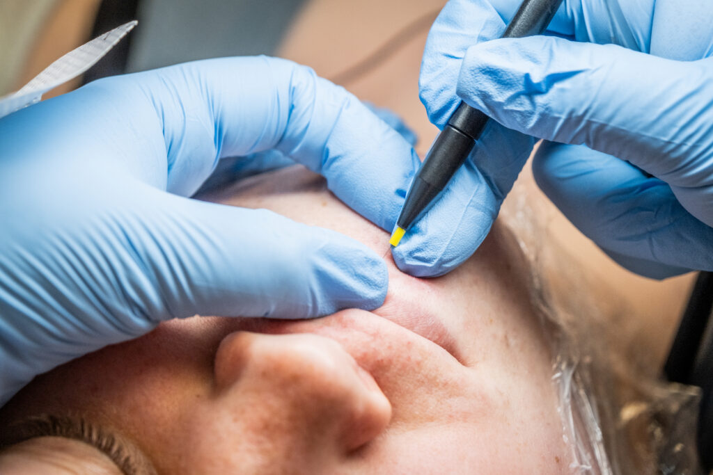 Electrolysis hair removal being performed on a patient's lower lip by a provider wearing blue gloves.