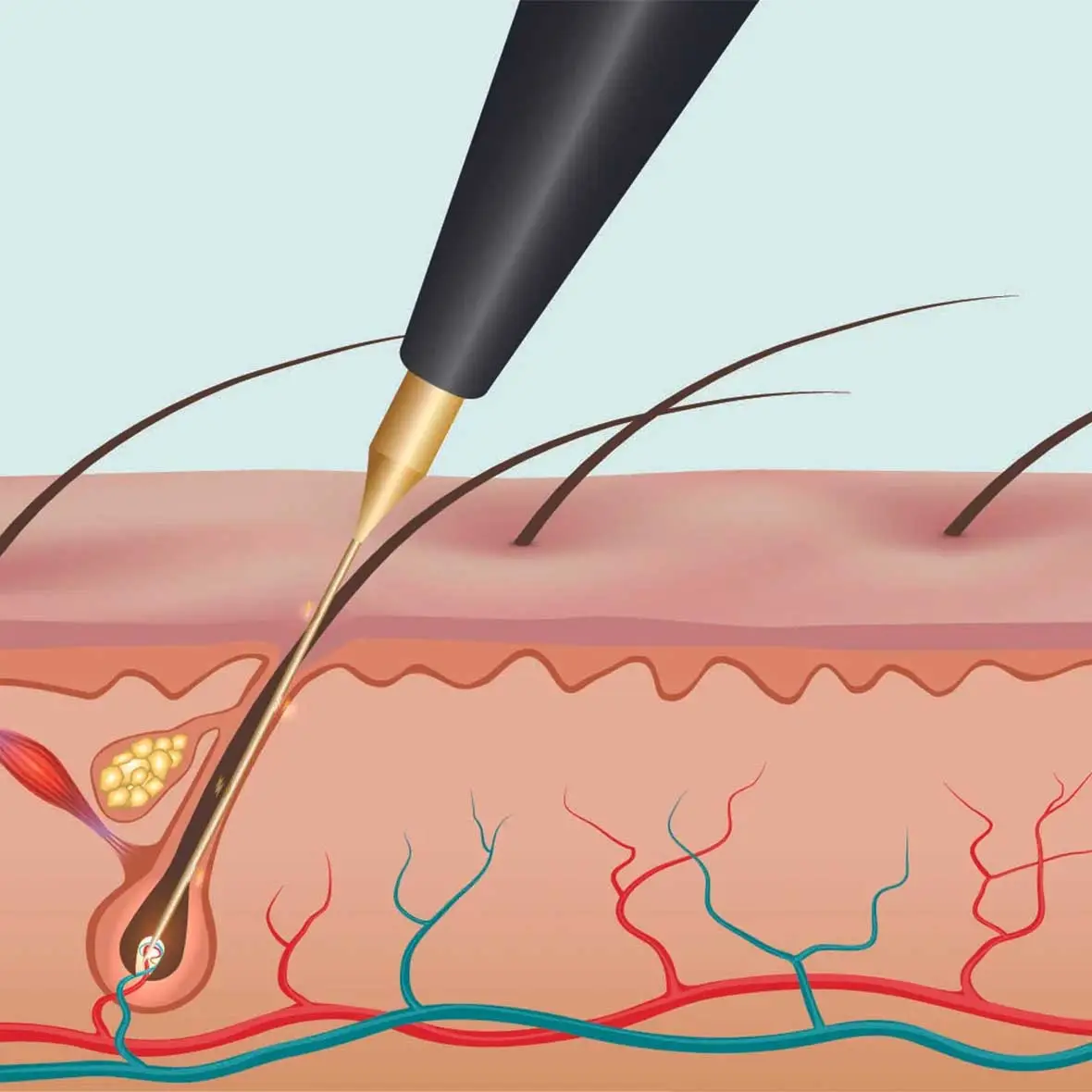 During electrolysis hair removal, an electrical impulse is applied to the hair follicle. | epidermis with hair follicles shown