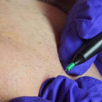 Electrolysis is a permanent method of hair removal that affects the hair follicle directly. | Shown: electrologist's hands applying probe to hair follicle.