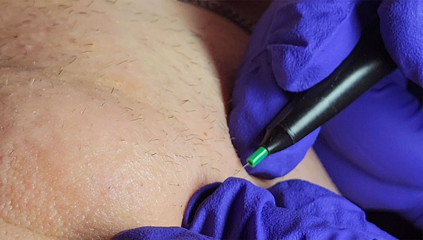 Electrolysis is a permanent method of hair removal that affects the hair follicle directly. | Shown: electrologist's hands applying probe to hair follicle.