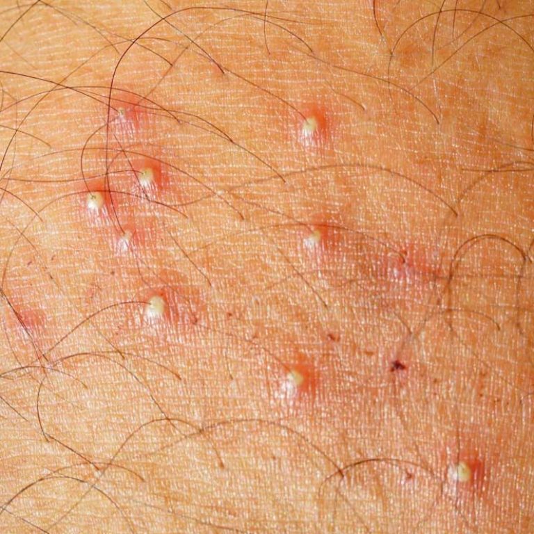 For clients suffering from folliculitis, electrolysis can bring lasting relief. | folliculitis shown