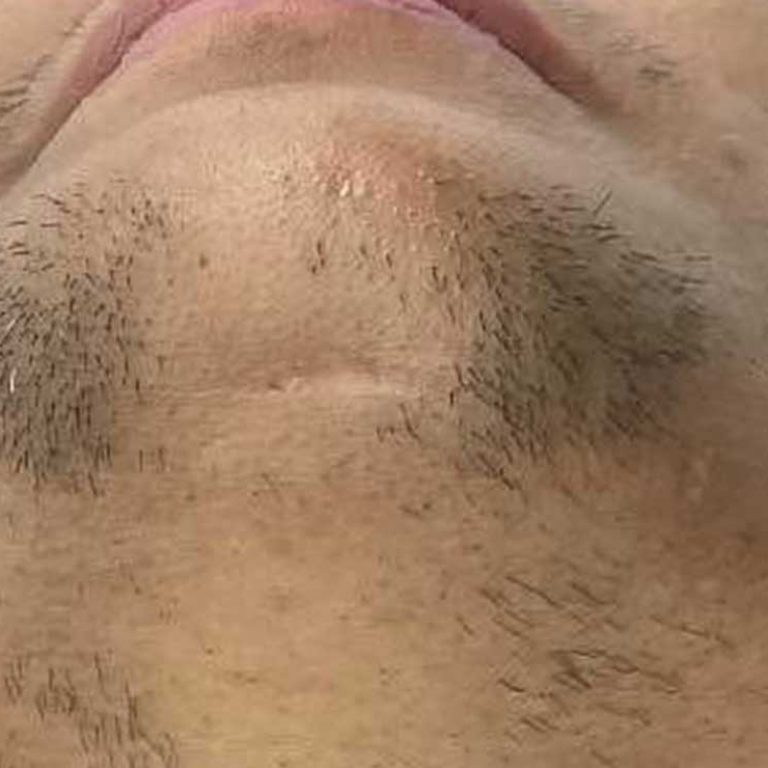 PCOS (polycystic ovary syndrome) commonly leads to hirsutism (extra hair). | Chin of client with PCOS shown.