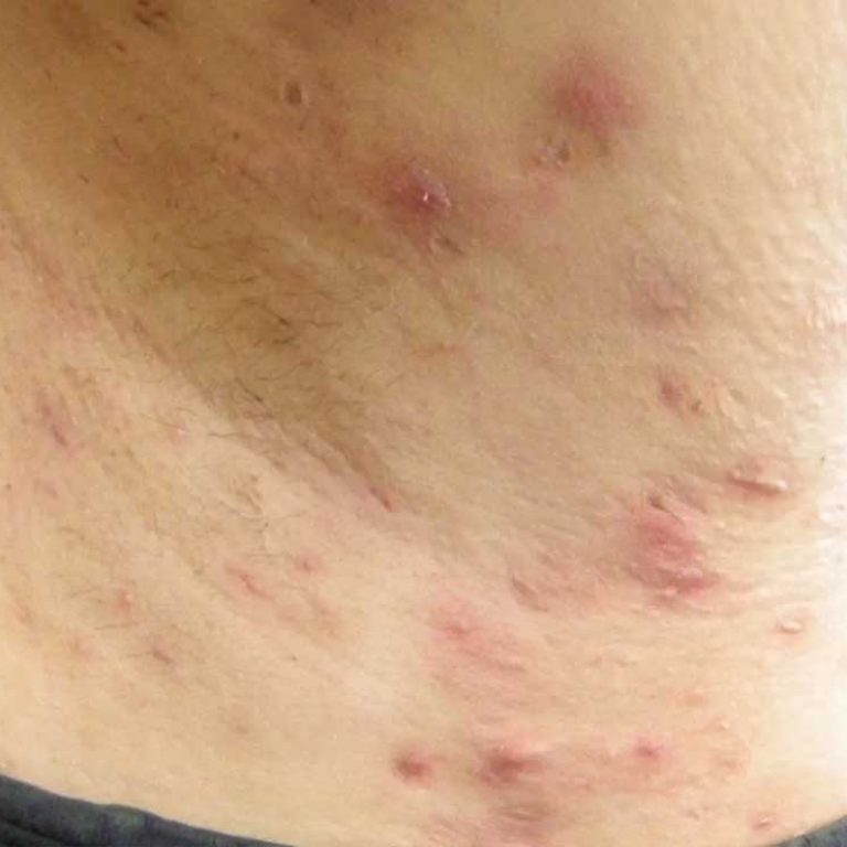 Hidradenitis Suppurativa (HS) - also known as Acne Inversa - can cause pain and distress. Electrolysis hair removal can be a permanent solution. | armpit with HS shown.