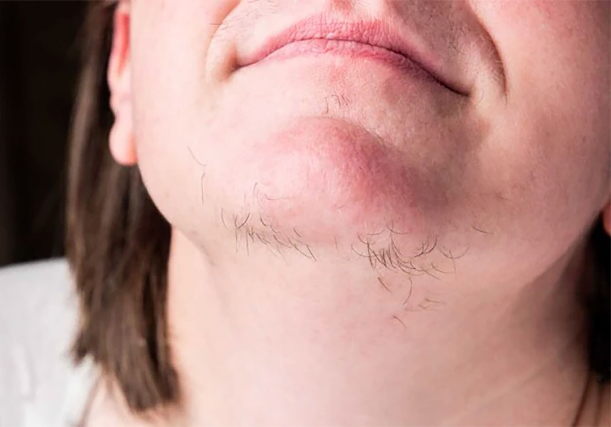 Unwanted hair can grow due to hormonals imbalances.